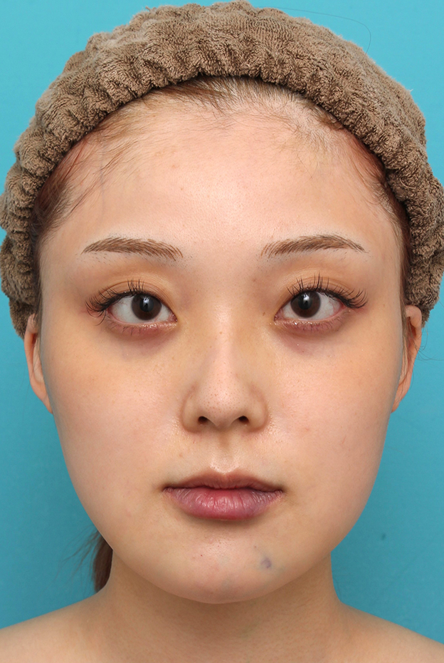 あご形成（シリコンプロテーゼ）,シリコンプロテーゼで顎をシャープに前方に出した20代女性の症例写真,手術直後,mainpic_ago028b.jpg
