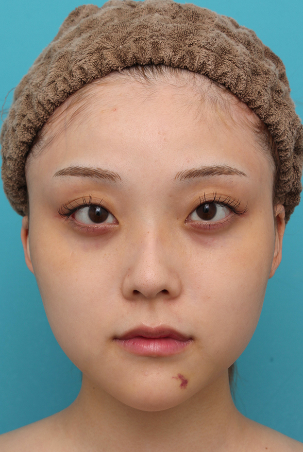 あご形成（シリコンプロテーゼ）,シリコンプロテーゼで顎をシャープに前方に出した20代女性の症例写真,1週間後,mainpic_ago028c.jpg