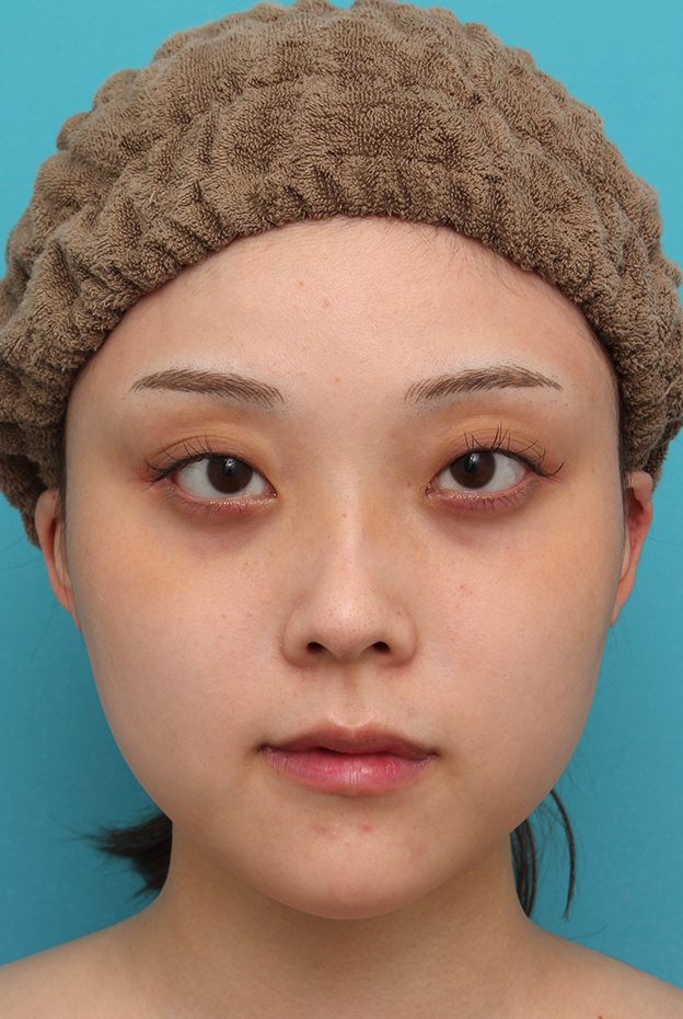 あご形成（シリコンプロテーゼ）,シリコンプロテーゼで顎をシャープに前方に出した20代女性の症例写真,3週間後,mainpic_ago028d.jpg