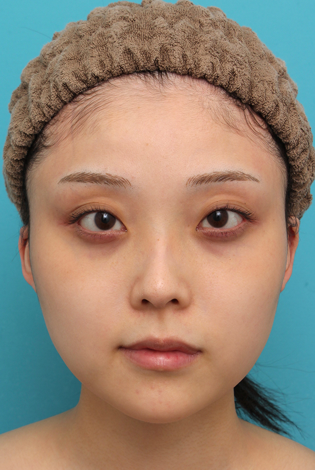 あご形成（シリコンプロテーゼ）,シリコンプロテーゼで顎をシャープに前方に出した20代女性の症例写真,4ヶ月後,mainpic_ago028e.jpg