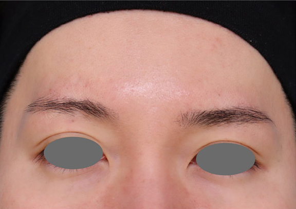 症例写真,肌育注射（プルリアル）を行った症例写真,After（3ヶ月後）,ba_hadaiku001_b03.jpg