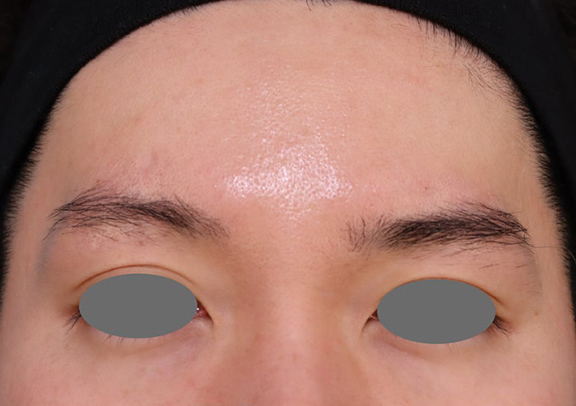 症例写真,肌育注射（プルリアル）を行った症例写真,Before,ba_hadaiku001_b03.jpg