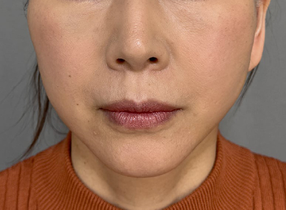 フルフェイスリフト,フルフェイスリフトでフェイスラインと首のたるみを改善した症例写真,After（2週間後）,ba_facelift009_a01.jpg