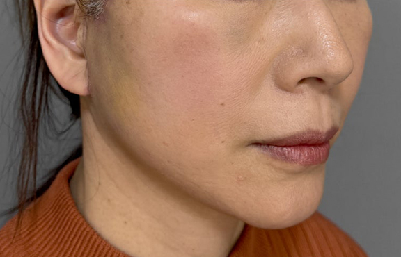 フルフェイスリフト,フルフェイスリフトでフェイスラインと首のたるみを改善した症例写真,After(2週間後),ba_facelift009_b02.jpg