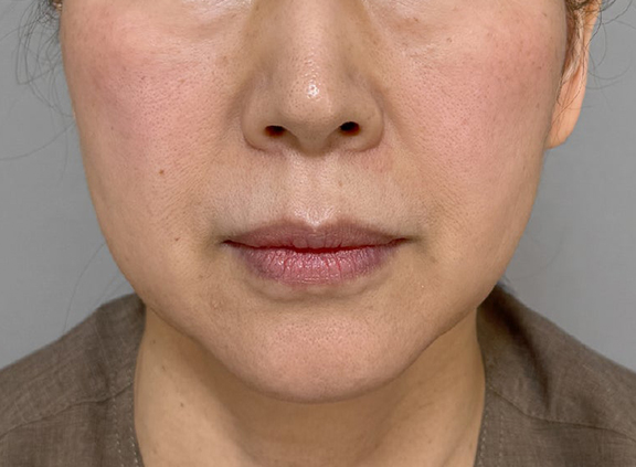 フルフェイスリフト,フルフェイスリフトでフェイスラインと首のたるみを改善した症例写真,Before,ba_facelift009_b01.jpg