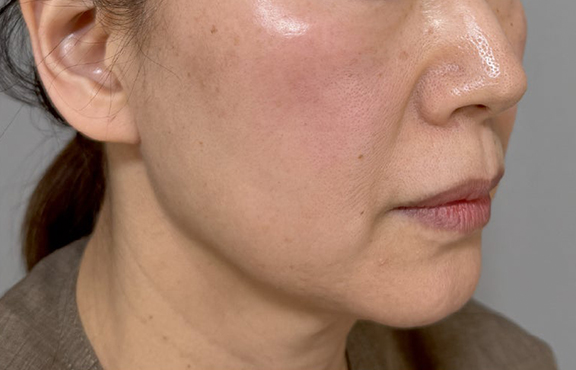 フルフェイスリフト,フルフェイスリフトでフェイスラインと首のたるみを改善した症例写真,Before,ba_facelift009_b02.jpg