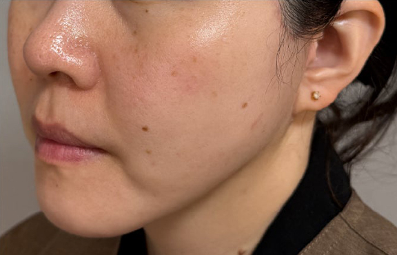 症例写真,ミニフェイスリフトと脂肪吸引(あご下)を行った症例写真,After(6ヶ月後),ba_minilift026_b02.jpg