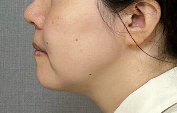 症例写真,ミニフェイスリフトと脂肪吸引(あご下)を行った症例写真,Before,ba_minilift026_b03.jpg