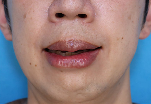 症例写真,上下の口唇の厚みに口唇縮小術を行った40代男性の症例写真,After(1ヶ月後),ba_usuku029_b02.jpg