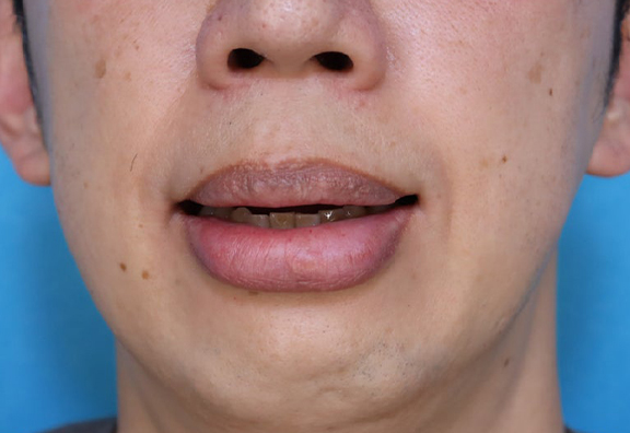 症例写真,上下の口唇の厚みに口唇縮小術を行った40代男性の症例写真,Before,ba_usuku029_b02.jpg