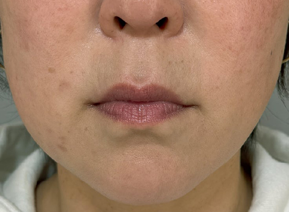 口角挙上術,口角挙上術を行った症例写真,After（3ヶ月後）,ba_lipsup001_a01.jpg