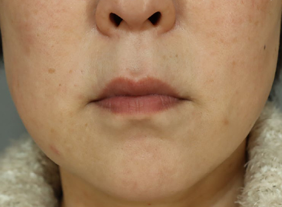 口角挙上術,口角挙上術を行った症例写真,Before,ba_lipsup001_b01.jpg