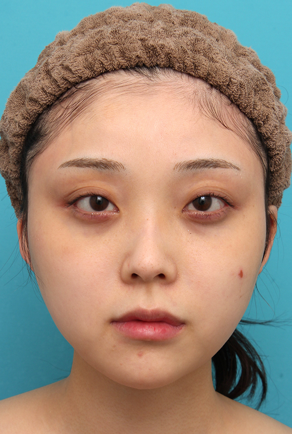 エラボトックス注射で小顔になった20代女性の症例写真,After（3ヶ月後）,ba_botox_puchi030_a01.jpg