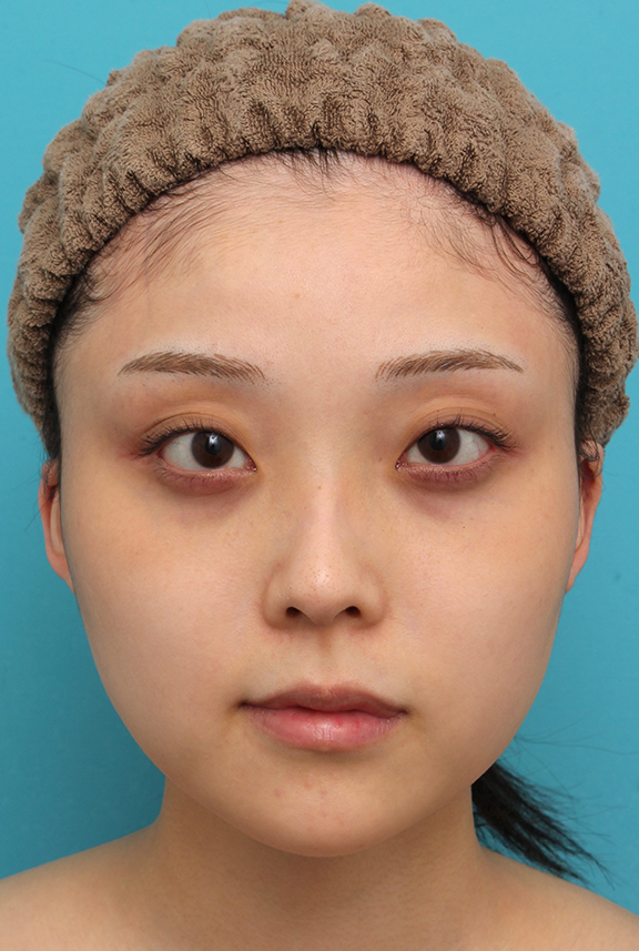 エラボトックス注射で小顔になった20代女性の症例写真,Before,ba_botox_puchi030_b01.jpg