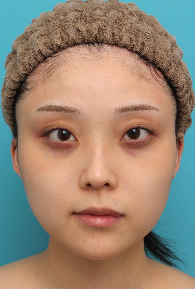 症例写真,エラボトックス注射で小顔になった20代女性の症例写真,治療前,mainpic_botox_puchi030a.jpg
