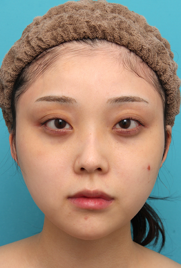 症例写真,エラボトックス注射で小顔になった20代女性の症例写真,3ヶ月後,mainpic_botox_puchi030c.jpg