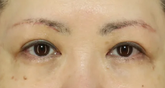 眉下切開で瞼の厚ぼったさを改善した症例写真,After（1ヶ月後）,ba_jougankenlift016_a01.jpg