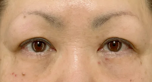 眉下切開で瞼の厚ぼったさを改善した症例写真,Before,ba_jougankenlift016_b01.jpg
