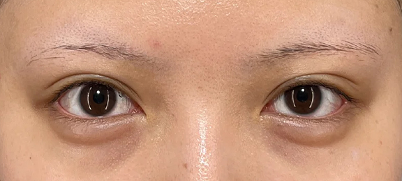 裏留め埋没法で右目は二重を幅を広げ、左目は三重になっている状態を改善した症例写真,After（1ヶ月後）,ba_maibotsu2013_a01.jpg