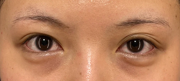 裏留め埋没法で右目は二重を幅を広げ、左目は三重になっている状態を改善した症例写真,Before,ba_maibotsu2013_b01.jpg