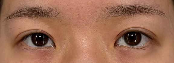 二重まぶた・全切開法と垂れ目形成でつり上がった目元を優しい印象にした症例写真,After（1ヶ月後）,ba_panda025_a01.jpg