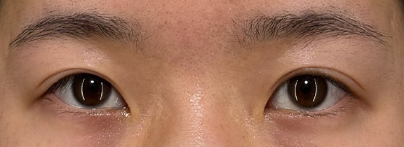 二重まぶた・全切開法と垂れ目形成でつり上がった目元を優しい印象にした症例写真,Before,ba_panda025_b01.jpg