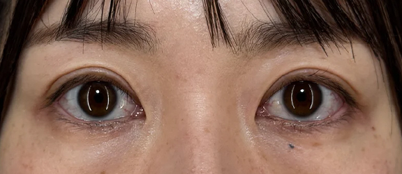 二重まぶた・全切開法を行い左右差を改善した症例写真,After（3ヶ月後）,ba_sekkai111_a01.jpg