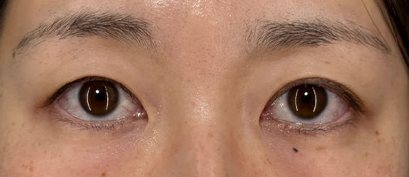 二重まぶた・全切開法を行い左右差を改善した症例写真,Before,ba_sekkai111_b01.jpg