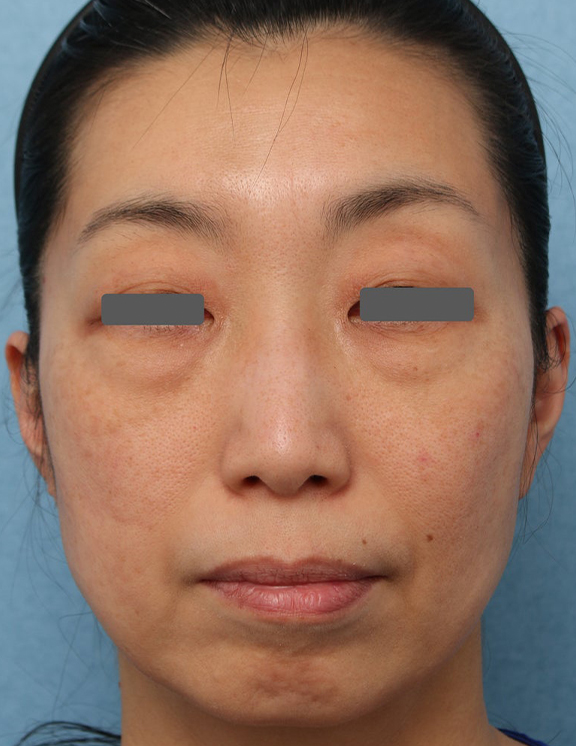 Vシェイプリフト（ヒアルロン酸注射）でクマやフェイスラインを改善した症例写真,Before,ba_v_shapelift028_b01.jpg