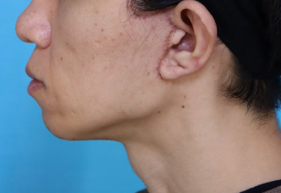 症例写真,マリオネットラインのたるみをミニフェイスリフトで改善した40代男性の症例写真,After（1ヶ月後）,ba_minilift027_b02.jpg