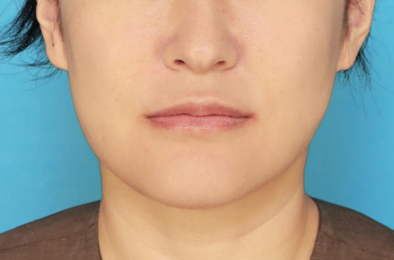 1Day Yes!小顔術,二重あご改善,1Day Yes!小顔術を行い、8ヶ月後の症例写真,After（8ヶ月後）,ba_1day_kogao003_a01.jpg