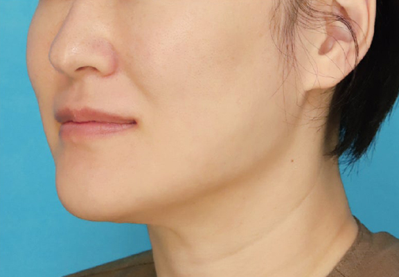 症例写真,1Day Yes!小顔術を行い、8ヶ月後の症例写真,After（8ヶ月後）,ba_1day_kogao003_b02.jpg