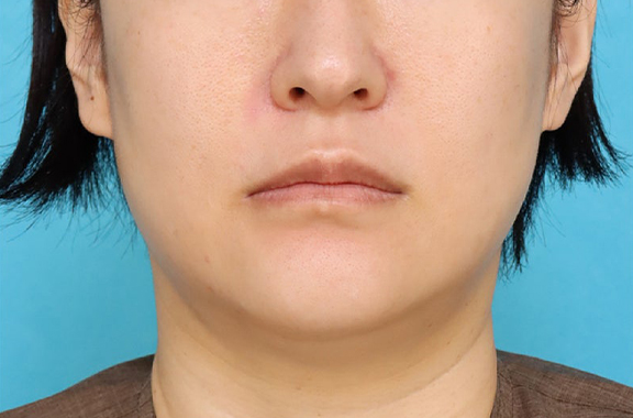 1Day Yes!小顔術,二重あご改善,1Day Yes!小顔術を行い、8ヶ月後の症例写真,Before,ba_1day_kogao003_b01.jpg