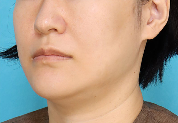 症例写真,1Day Yes!小顔術を行い、8ヶ月後の症例写真,Before,ba_1day_kogao003_b02.jpg