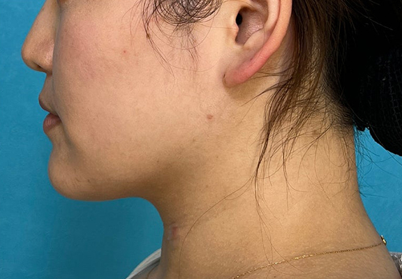 1Day Yes!小顔術,二重あご改善,1Day Yes!小顔術で顎回りのもたつきを改善した症例写真,After（3ヶ月後）,ba_1day_kogao004_a01.jpg