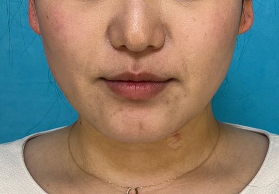 症例写真,1Day Yes!小顔術で顎回りのもたつきを改善した症例写真,After（3ヶ月後）,ba_1day_kogao004_b02.jpg