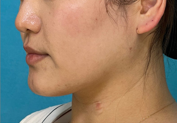 症例写真,1Day Yes!小顔術で顎回りのもたつきを改善した症例写真,After（3ヶ月後）,ba_1day_kogao004_b03.jpg