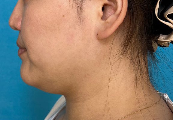 1Day Yes!小顔術,二重あご改善,1Day Yes!小顔術で顎回りのもたつきを改善した症例写真,Before,ba_1day_kogao004_b01.jpg