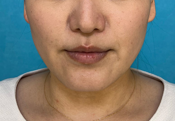 症例写真,1Day Yes!小顔術で顎回りのもたつきを改善した症例写真,Before,ba_1day_kogao004_b02.jpg