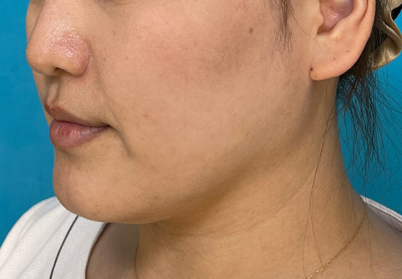 症例写真,1Day Yes!小顔術で顎回りのもたつきを改善した症例写真,Before,ba_1day_kogao004_b03.jpg