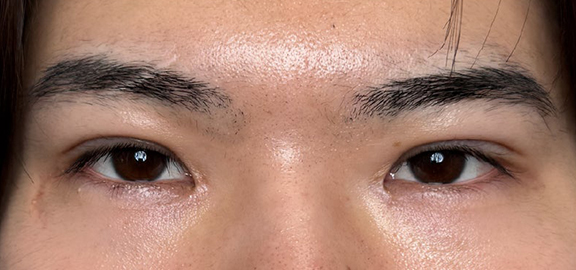 二重全切開＋目頭切開で自然な二重を作った20代男性の症例写真,After（3ヶ月後）,ba_sekkai112_a01.jpg