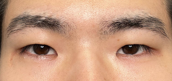 二重全切開＋目頭切開で自然な二重を作った20代男性の症例写真,Before,ba_sekkai112_b01.jpg
