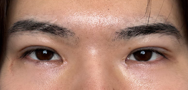 症例写真,二重全切開＋目頭切開で自然な二重を作った20代男性の症例写真,3ヶ月後,mainpic_sekkai112e.jpg