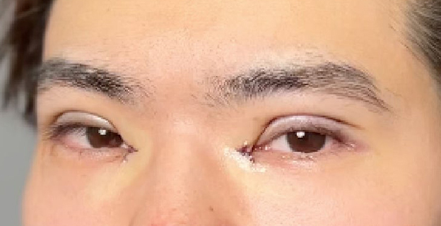 症例写真,二重全切開＋目頭切開で自然な二重を作った20代男性の症例写真,施術直後,mainpic_sekkai112g.jpg