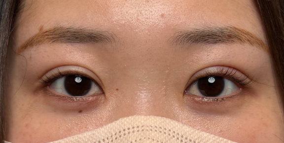 埋没法で取れてしまった二重を、全切開法で希望の幅に整えた20代女性の症例写真,After（メイクなし）
（3ヶ月後）,ba_sekkai113_a01.jpg