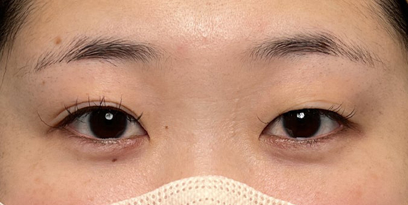 埋没法で取れてしまった二重を、全切開法で希望の幅に整えた20代女性の症例写真,Before,ba_sekkai113_b01.jpg