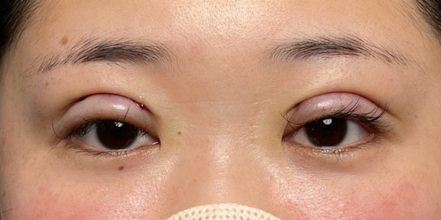 症例写真,埋没法で取れてしまった二重を、全切開法で希望の幅に整えた20代女性の症例写真,施術直後,futaezensekkai1_2.jpg