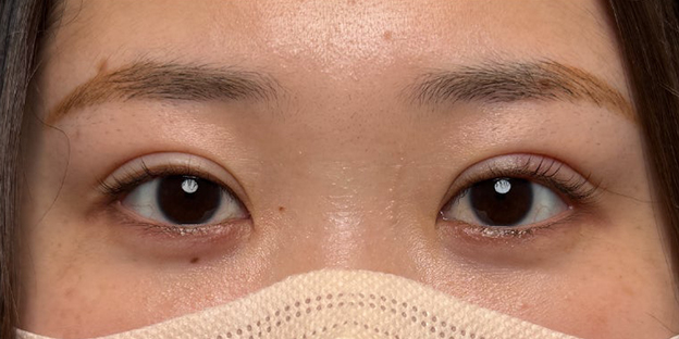 症例写真,埋没法で取れてしまった二重を、全切開法で希望の幅に整えた20代女性の症例写真,3ヶ月後,futaezensekkai1_5.jpg
