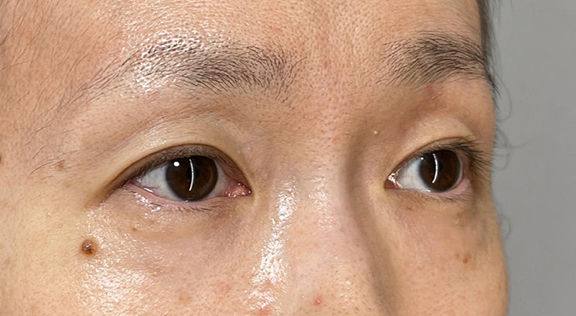 症例写真,厚みと重たさのある瞼に二重まぶた・埋没法（二針固定）を行った症例写真,After（1ヶ月後）,ba_maibotsu091_b02.jpg