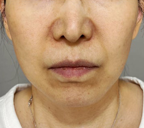 ミニフェイスリフトとあご下の脂肪吸引を行った症例写真,After（3ヶ月後）,ba_minilift028_a01.jpg